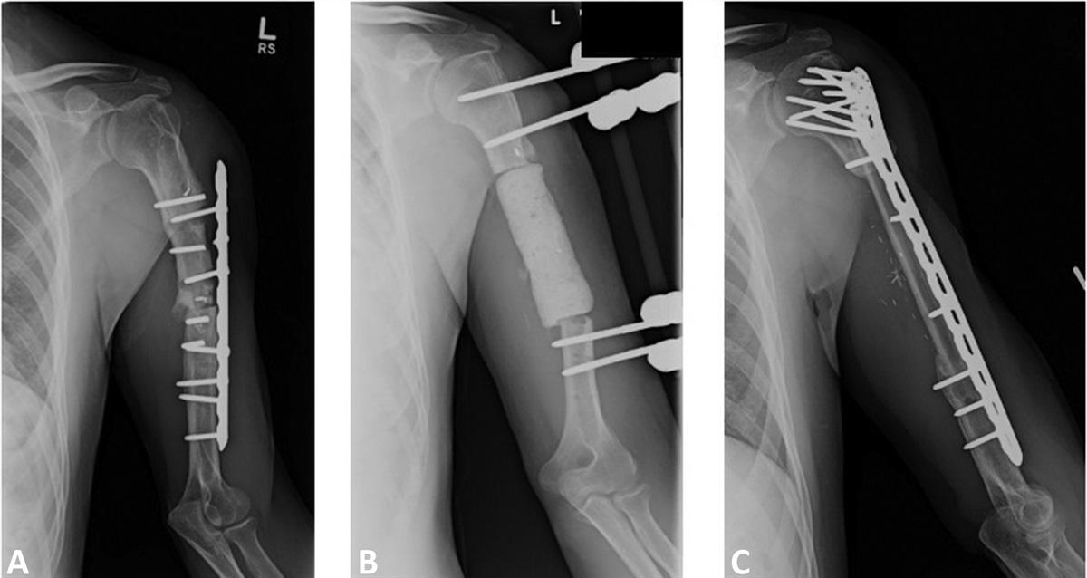 Free Vascularized Fibula Graft for Staged Reconstruction of Infected Humerus Nonunions