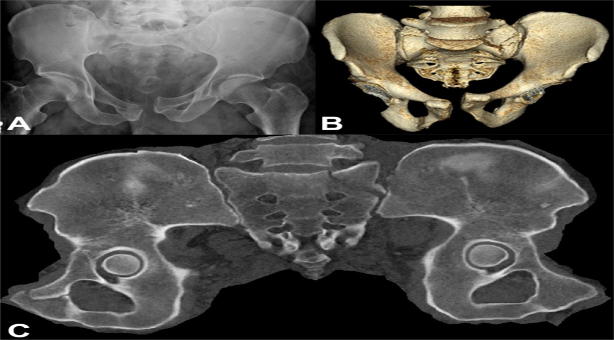 Mapping of Pelvic Ring Injuries From High-Energy Trauma Using Unfolded CT Image Technology