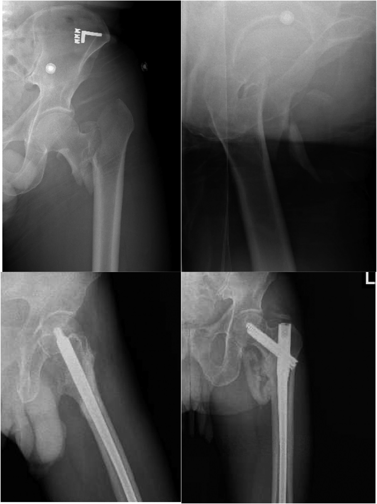 High- Versus Low-Energy Intertrochanteric Hip Fractures in Young Patients: Injury Characteristics and Factors Associated With Complications