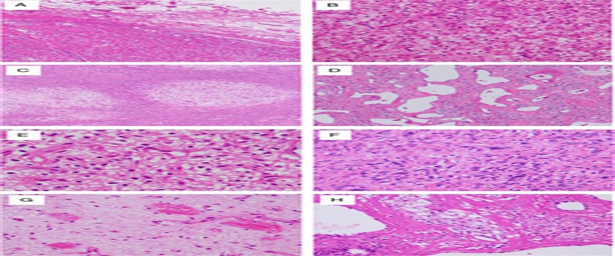 CYP1A1 Is a Useful Diagnostic Marker for Angiofibroma of Soft Tissue