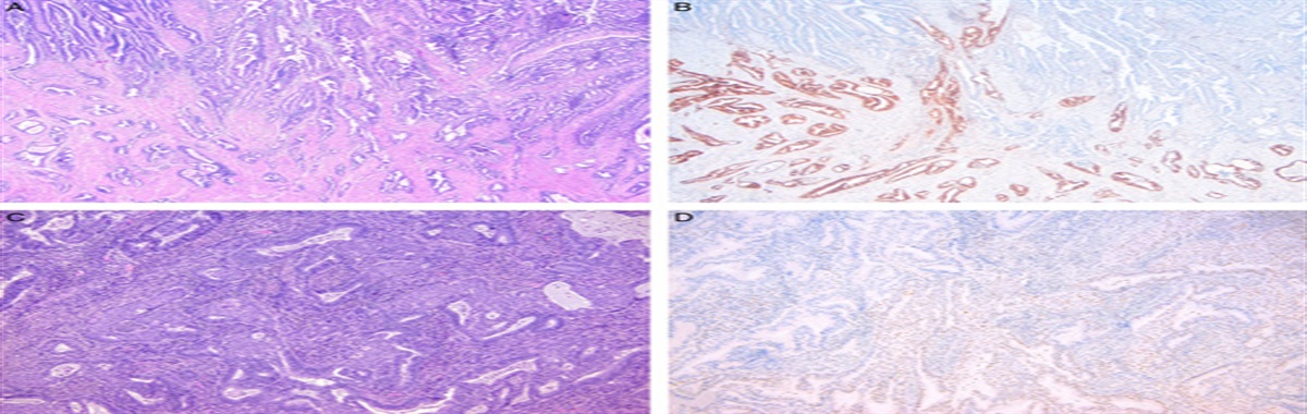 Endometrial Carcinomas With Subclonal Loss of Mismatch Repair Proteins: A Clinicopathologic and Genomic Study
