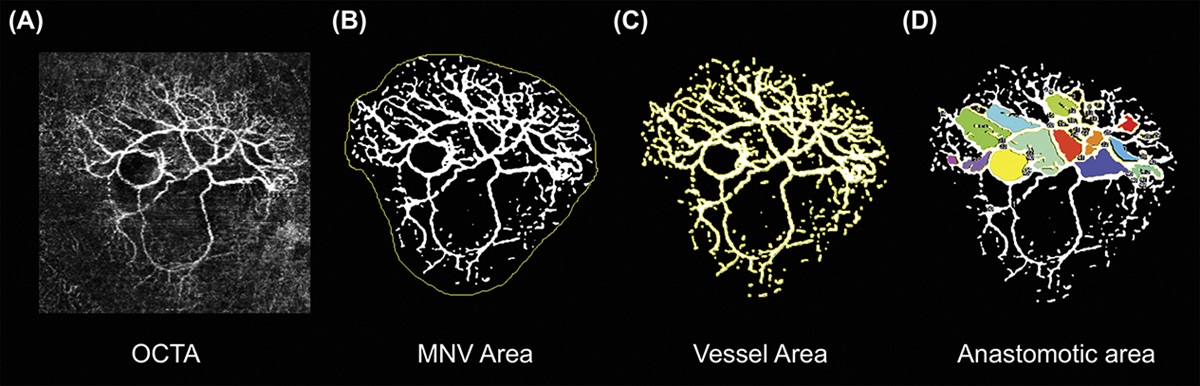 QUANTIFIED ANASTOMOTIC AREAS OF NEOVASCULARIZATION AS FACTORS ASSOCIATED WITH FREQUENT RECURRENCE IN NEOVASCULAR AGE-RELATED MACULAR DEGENERATION