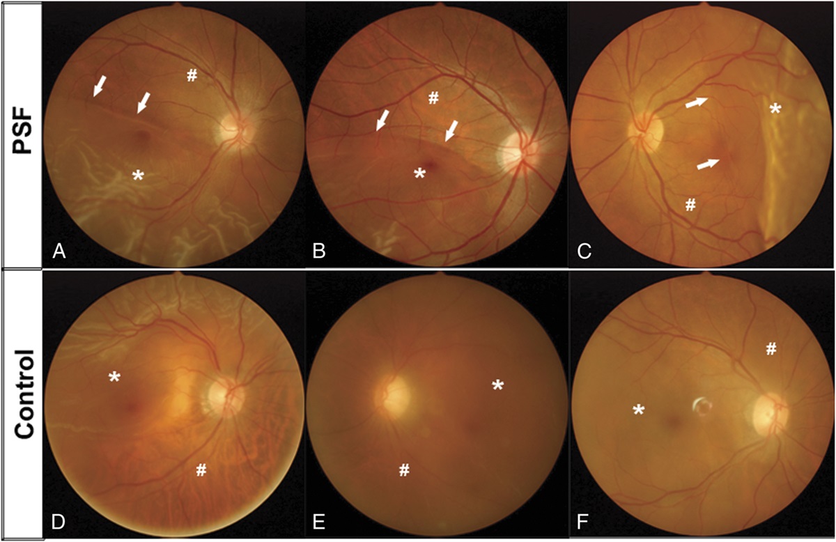 PREDISPOSING CHARACTERISTICS OF OPTICAL COHERENCE TOMOGRAPHY FOR PATIENTS WITH PERSISTENT SUBRETINAL FLUID AFTER SUCCESSFUL REPAIR OF RHEGMATOGENOUS RETINAL DETACHMENT