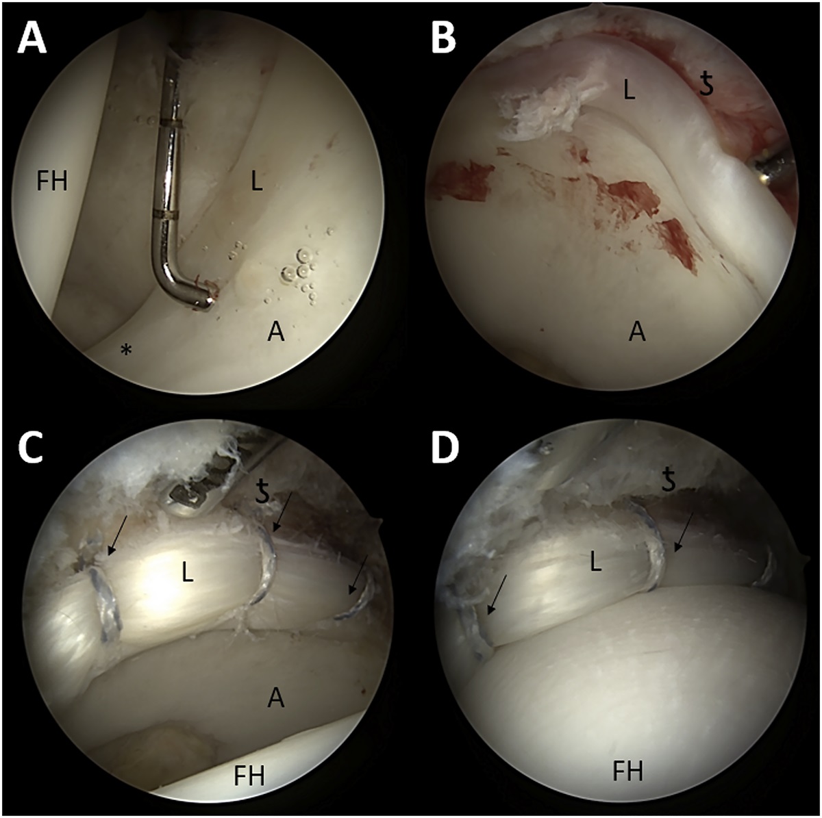 Borderline Dysplasia After Primary Hip Arthroscopy with Capsular Plication and Labral Preservation: Ten-Year Survivorship and Patient-Reported Outcomes