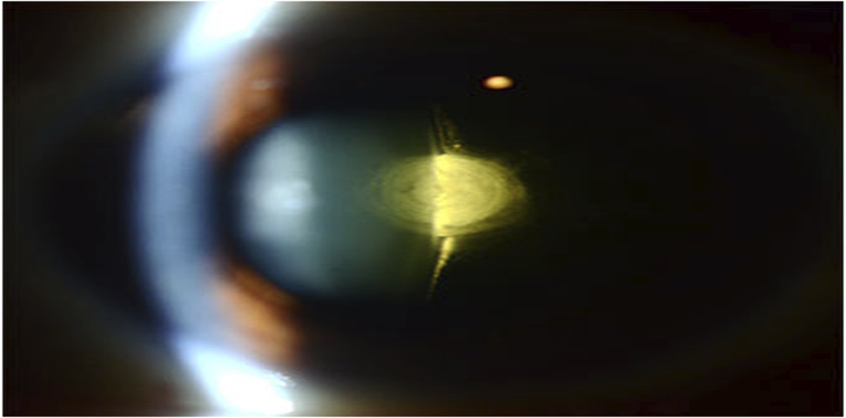 Approach to a spontaneously ruptured posterior polar cataract