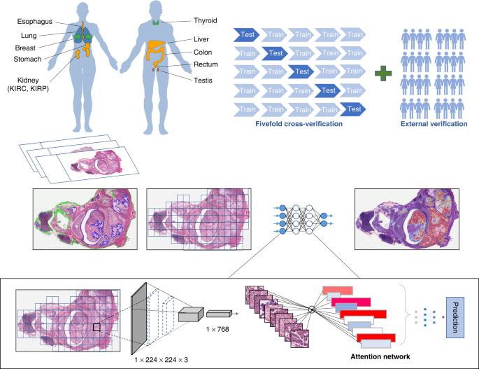 Deep learning-based pathology signature could reveal lymph node status and act as a novel prognostic marker across multiple cancer types