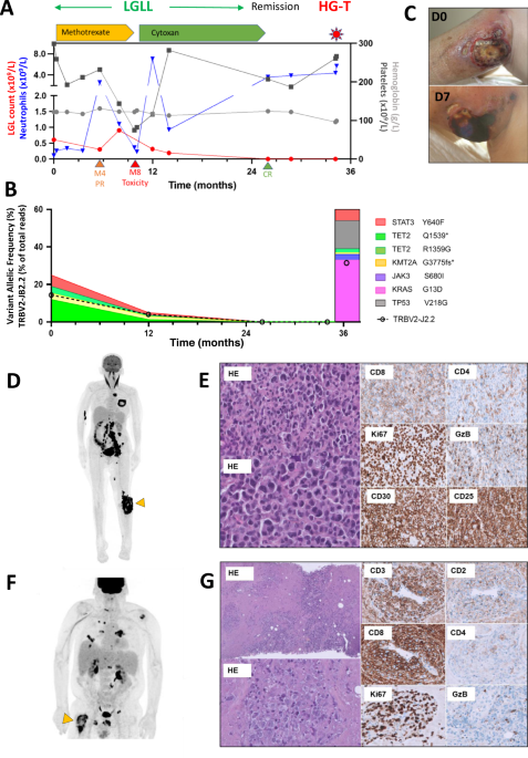 Molecular mechanisms underlying transformation of large granular lymphocytic leukemia to high-grade T-cell lymphoma
