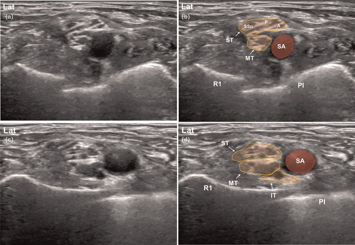 Modified first-targeted ultrasound window for selective brachial plexus trunk block may reduce the incidence of hemi-diaphragmatic paralysis