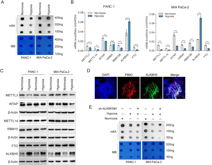m6A methylation regulates hypoxia-induced pancreatic cancer glycolytic metabolism through ALKBH5-HDAC4-HIF1α positive feedback loop