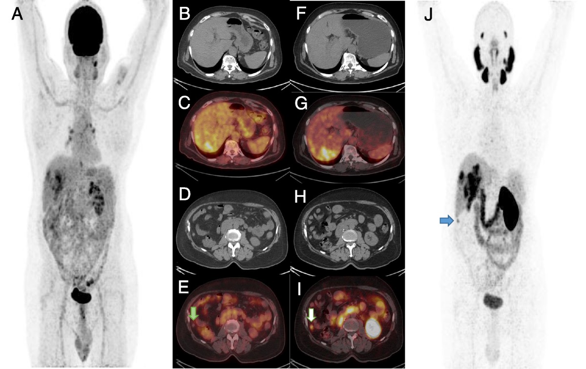 68Ga-PSMA PET/CT Detecting Metastatic Lesion of RCC: Missed on: 18: F-FDG PET/CT