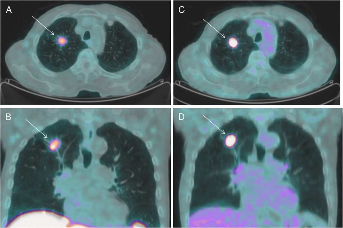 Can PSMA-Targeting PET/CT Be a Valuable Instrument to Assess the Presence of Brain Metastases in Lung Cancer Patients?: A Case Report