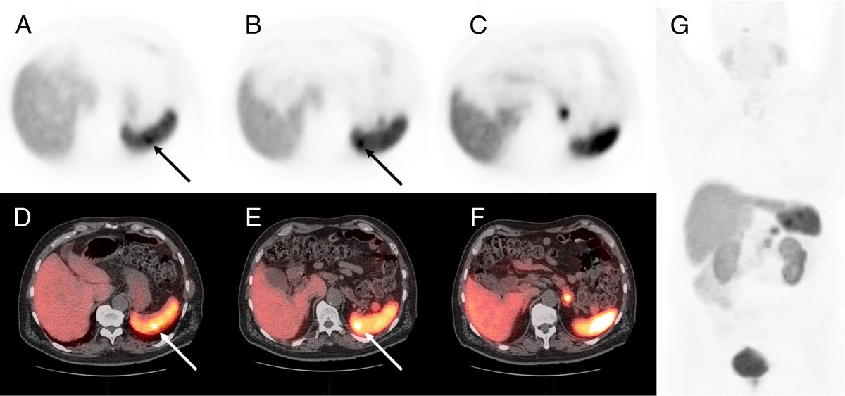 False-Positive Uptake in Splenic Hemangioma on 68Ga-DOTATATE PET/CT