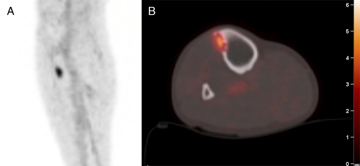 PSMA PET/CT Detection of Chondromyxoid Fibroma