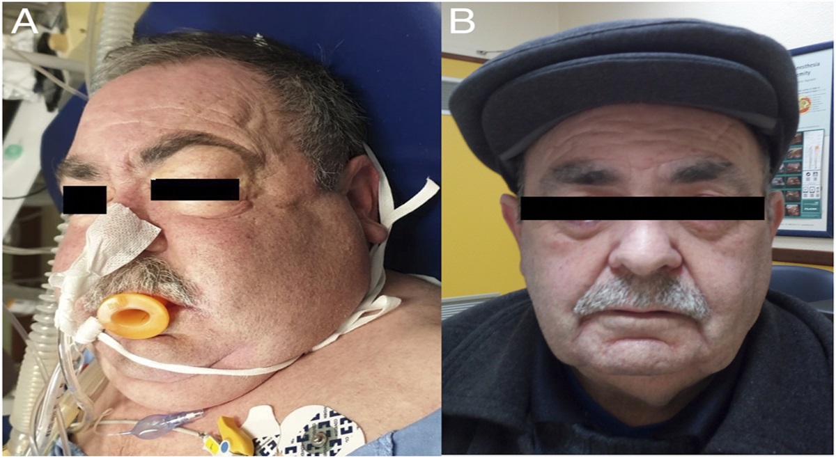 Widespread Emphysema After Elective Colonoscopy
