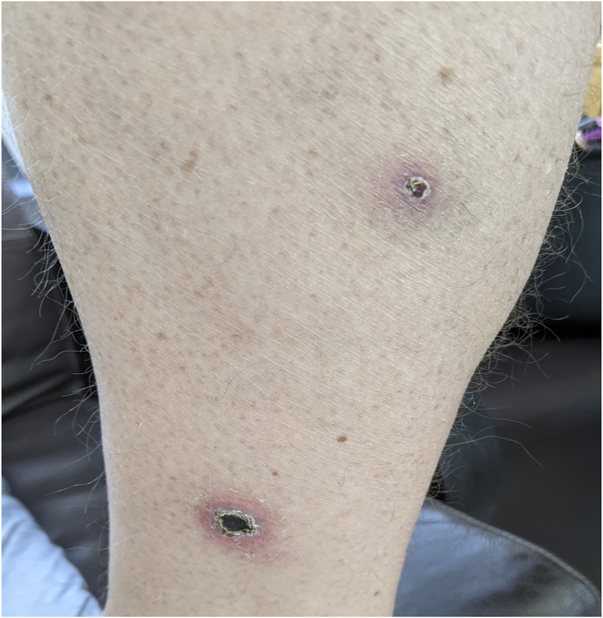 Azathioprine-Induced Hypersensitivity Vasculitis