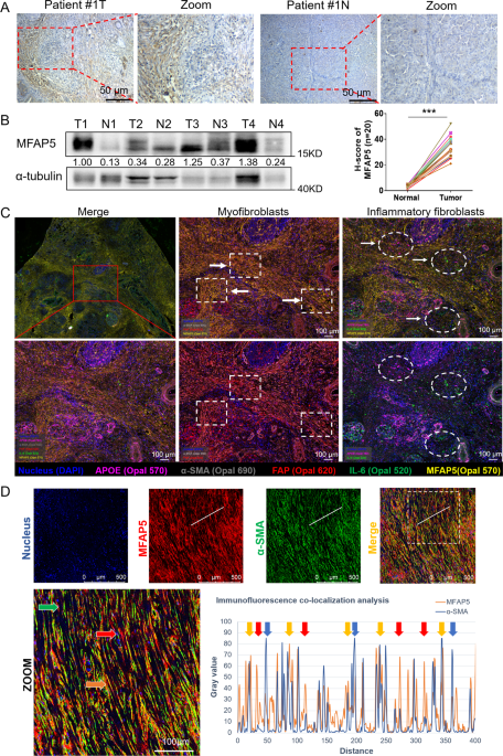 Targeting MFAP5 in cancer-associated fibroblasts sensitizes pancreatic cancer to PD-L1-based immunochemotherapy via remodeling the matrix