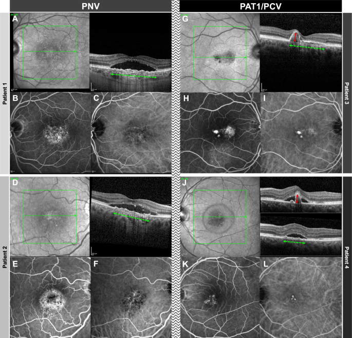 Optical coherence tomography-based misdiagnosis and morphological distinction in pachychoroid neovasculopathy vs. polypoidal choroidal vasculopathy