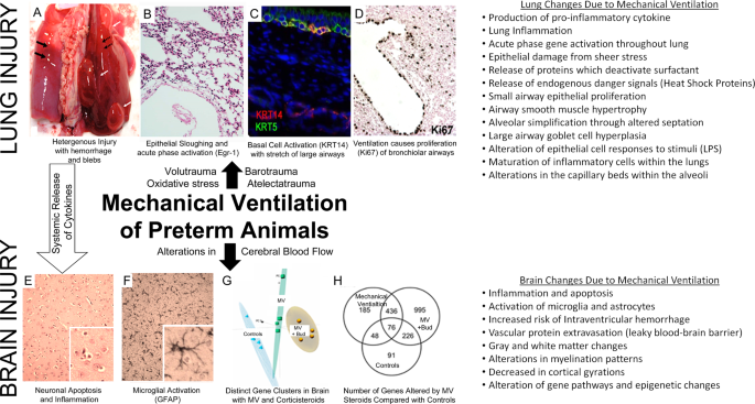 Preterm lung and brain responses to mechanical ventilation and corticosteroids