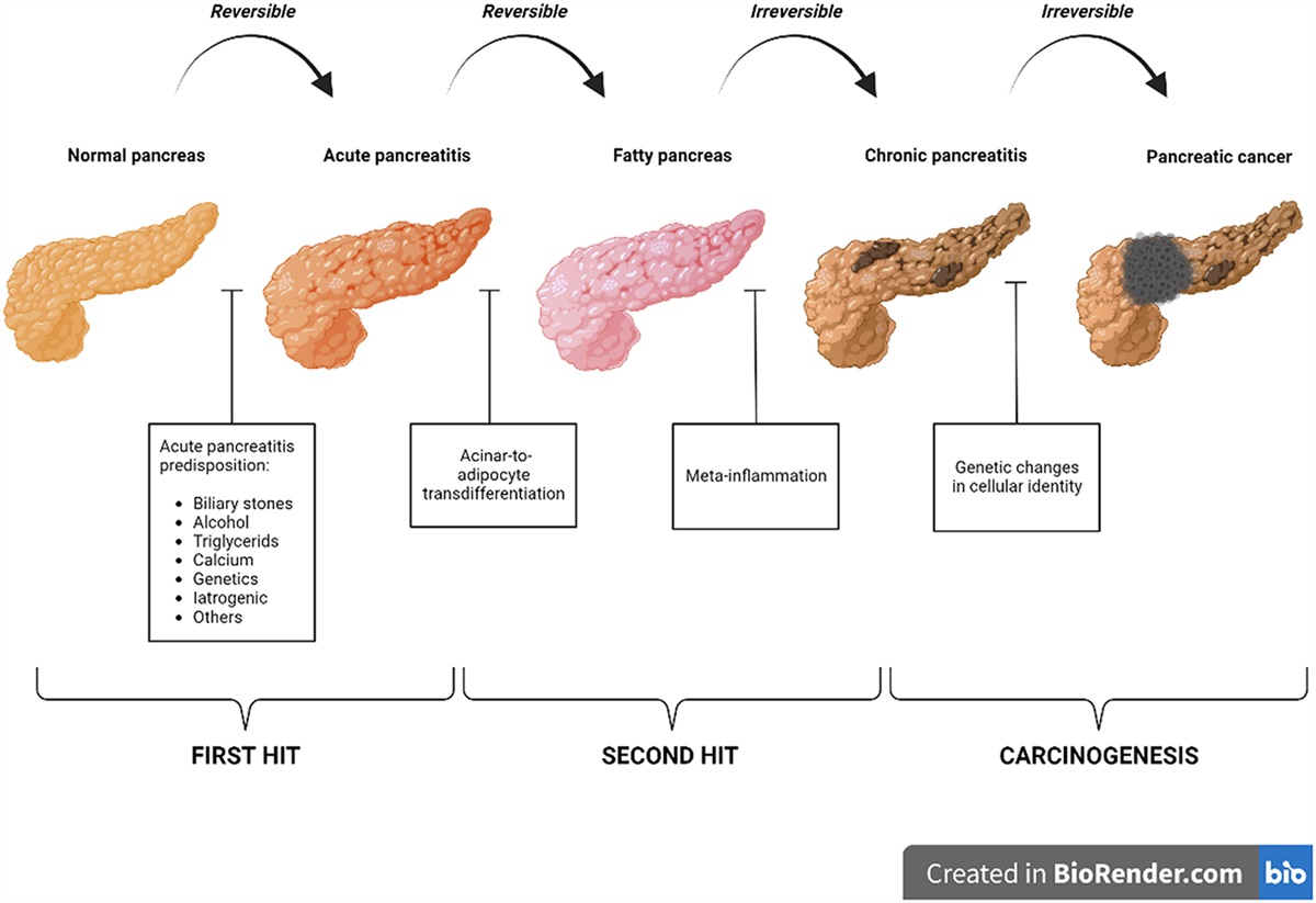 Intrapancreatic Fat Deposition: Cause or Consequence of First Acute Pancreatitis Attack?
