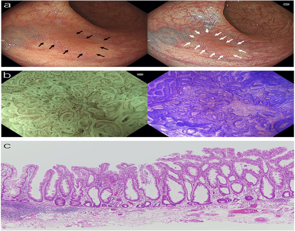 Sessile Serrated Lesion of the Rectum in Ulcerative Colitis Observed by Image-Enhanced Endoscopy