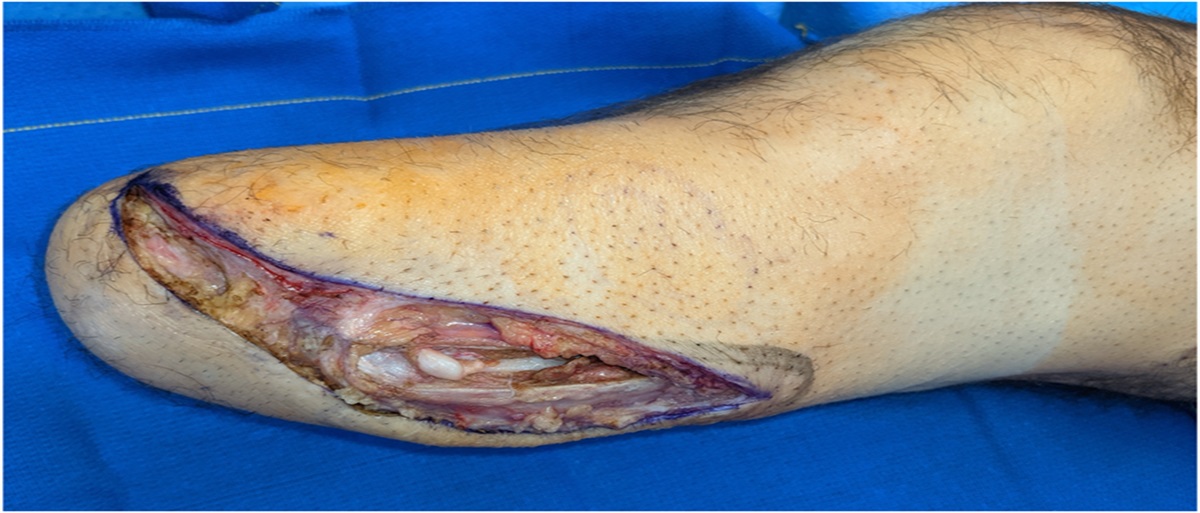 Transtibial Amputation With Fibulectomy and Fibular Collateral Ligament-Biceps Reconstruction: Surgical Technique and Clinical Experience