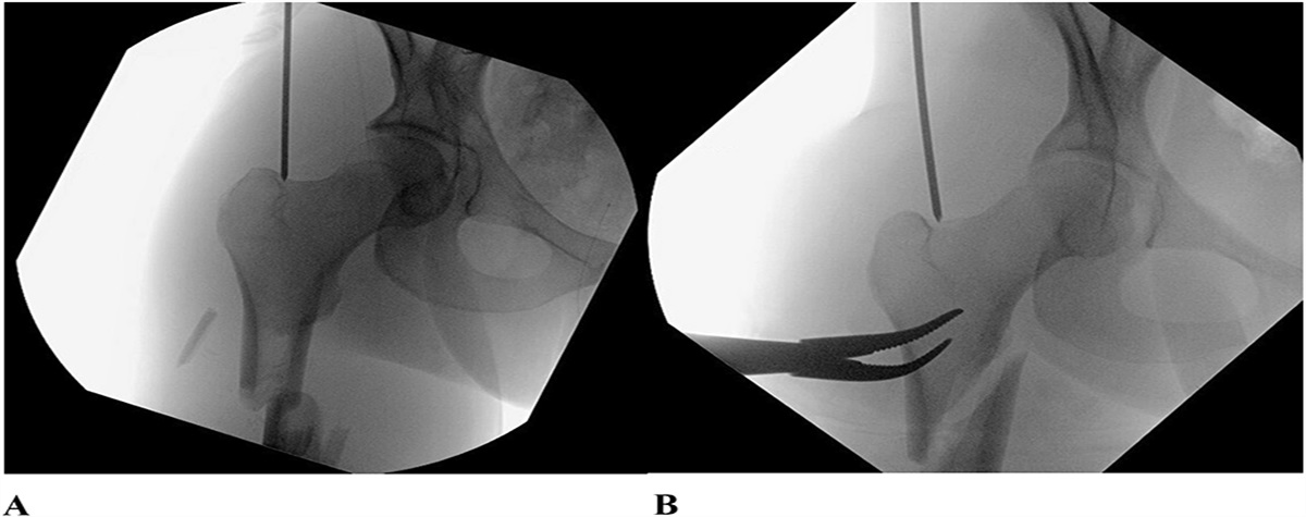 A Central Collinear Start Point for Reconstruction Nailing of Femur Fractures: A Technical Trick and Case Series