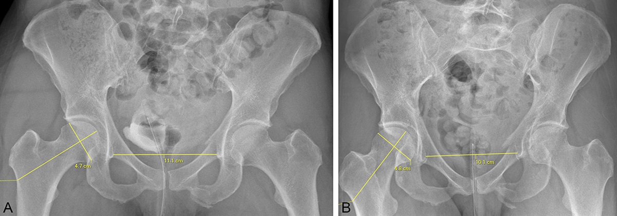 Operative Management of Stress-Positive Minimally Displaced Lateral Compression Type 1 (LC1) Pelvic Ring Injuries: Analysis of Outcomes Before and After Implementation of a Departmental Stress Protocol