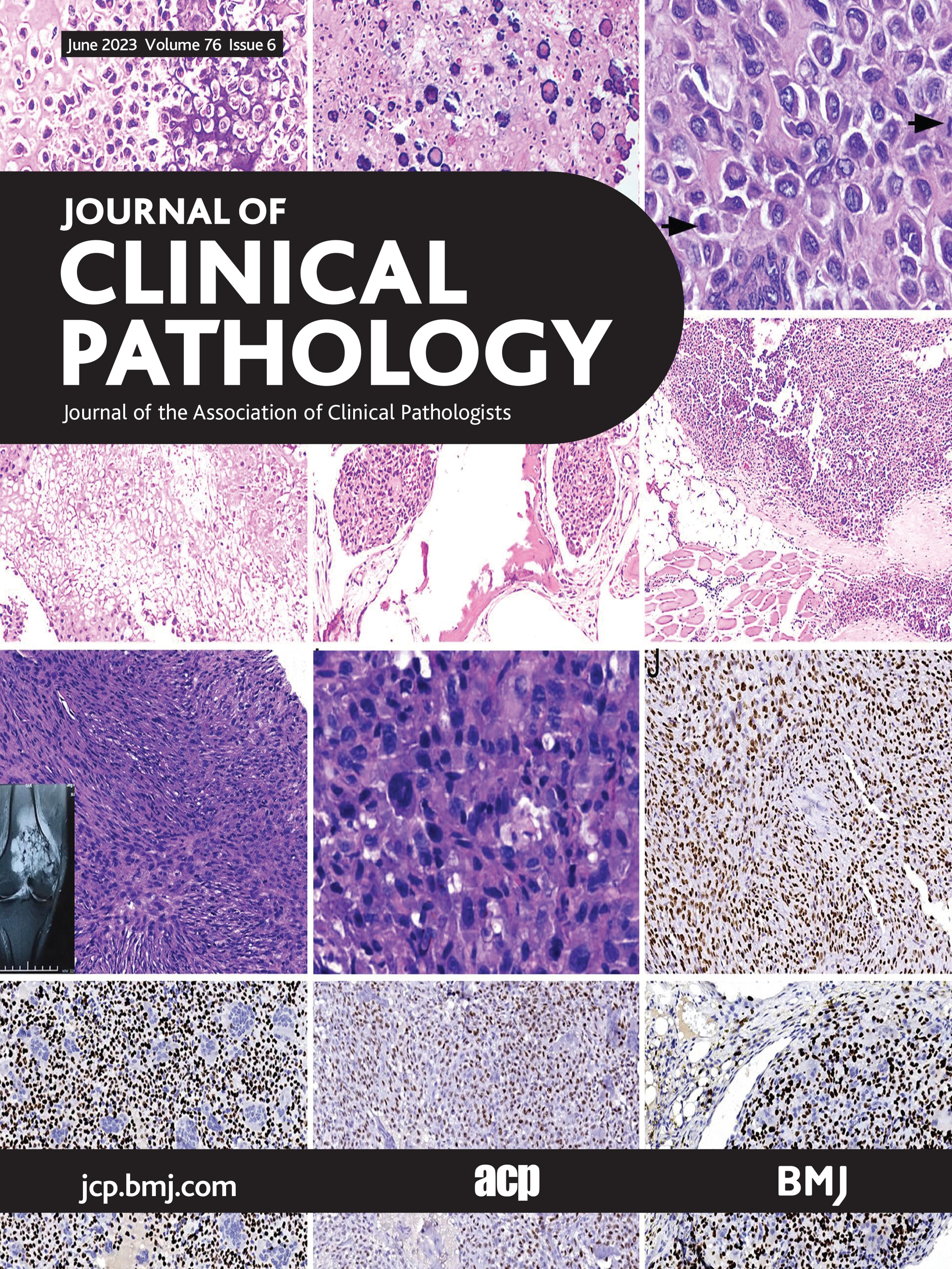 Chondroblastoma: clinicopathological analyses of 307 cases from a single institution in China and the diagnostic value of the H3F3 K36M mutant antibody
