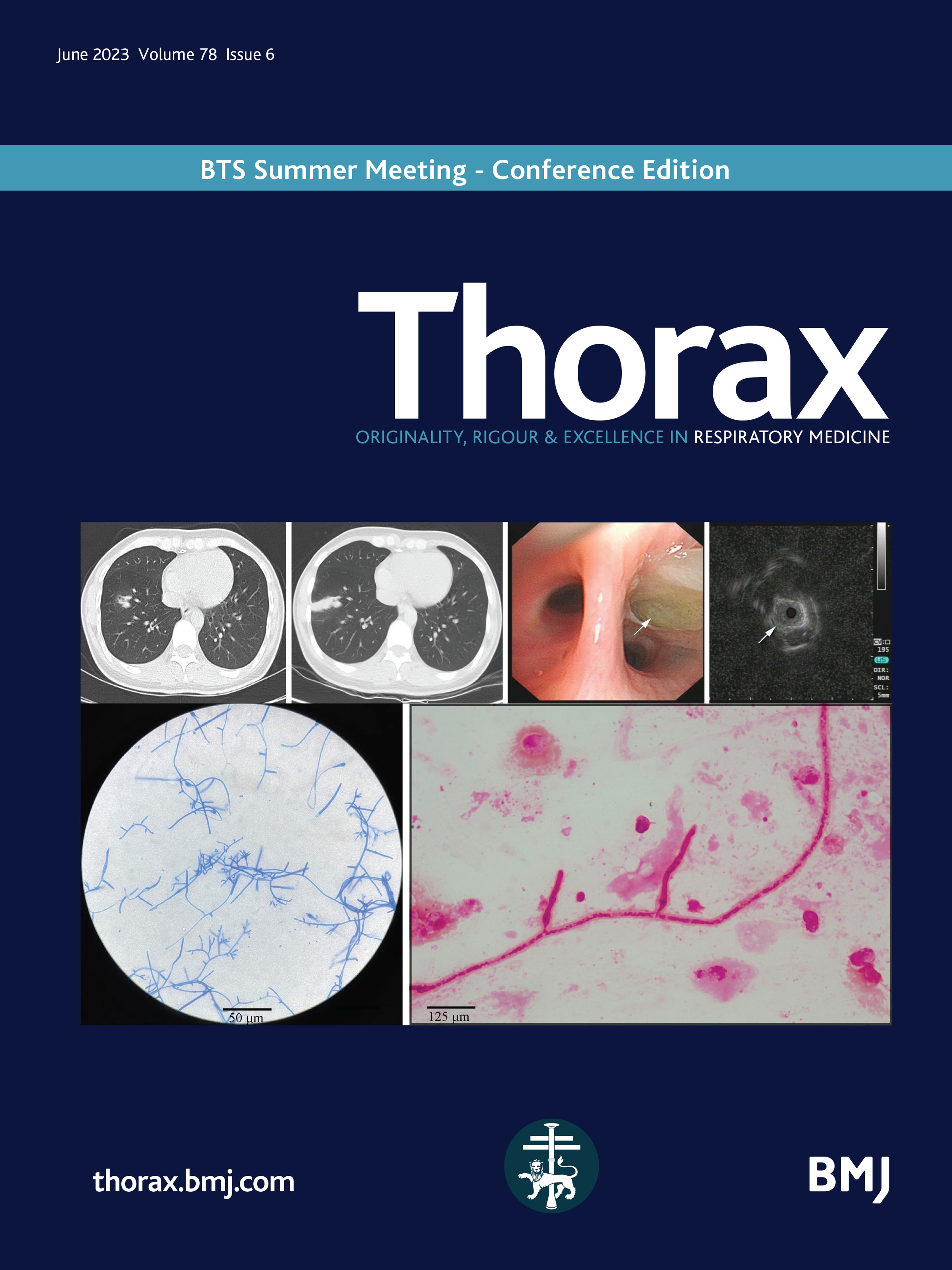 Invasive pulmonary infection caused by Trichoderma longibrachiatum