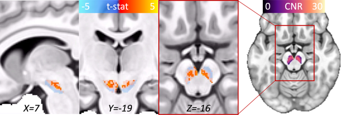 Probing midbrain dopamine function in pediatric obsessive-compulsive disorder via neuromelanin-sensitive magnetic resonance imaging