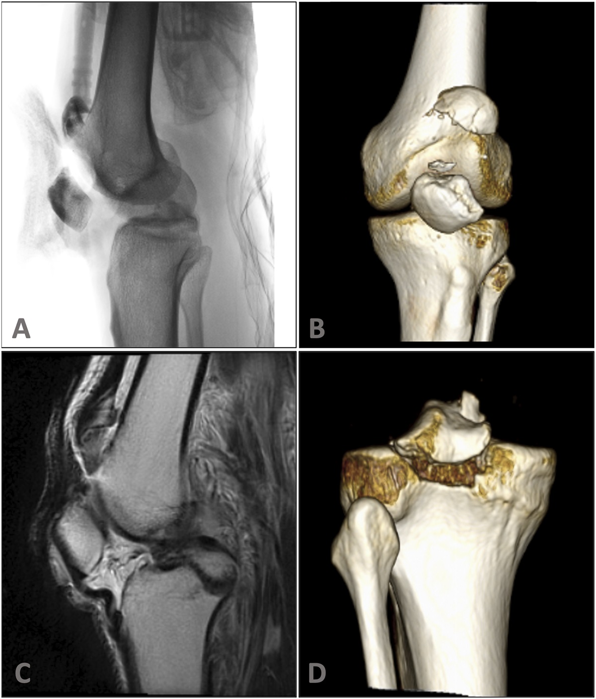 Extensor Mechanism Disruption Impacts Treatment of Dislocated and Multiligament Injured Knees: Treatment and Schenck Classification Recommendations Based on a Global Delphi Method