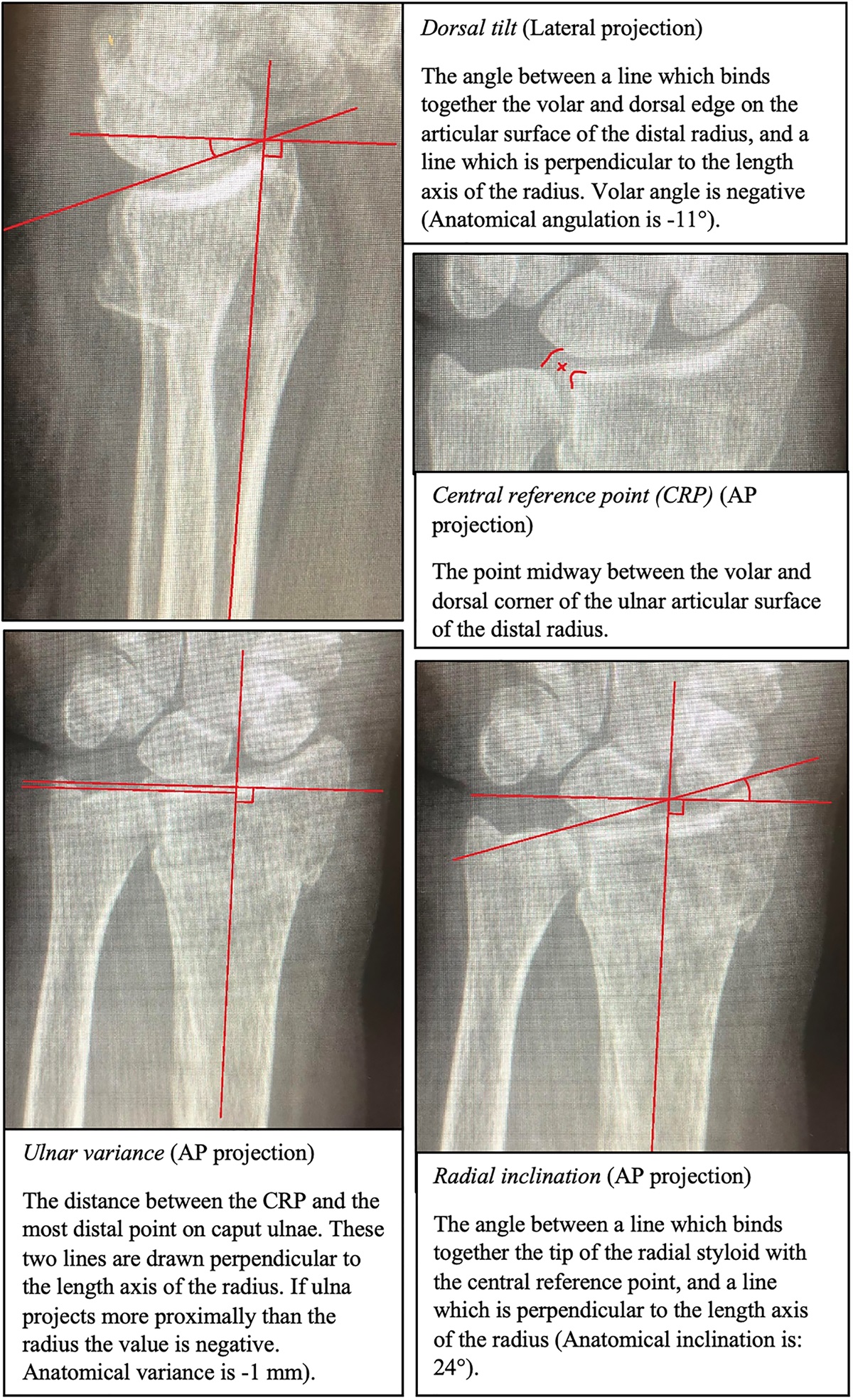 Association Between Radiographic and Clinical Outcomes Following Distal Radial Fractures: A Prospective Cohort Study with 1-Year Follow-up in 366 Patients