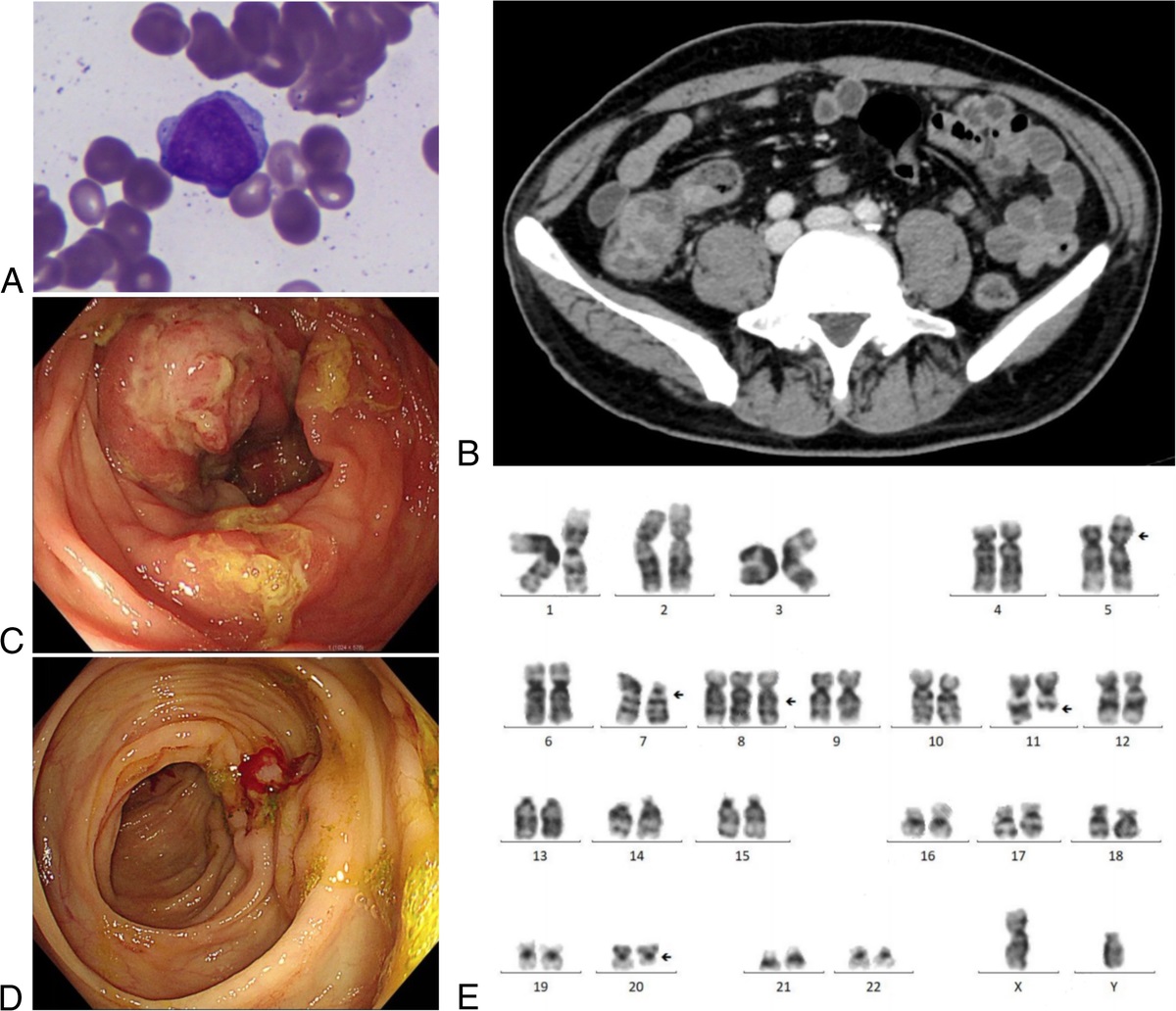 Gastrointestinal Behçet Disease Secondary to Myelodysplastic Syndrome