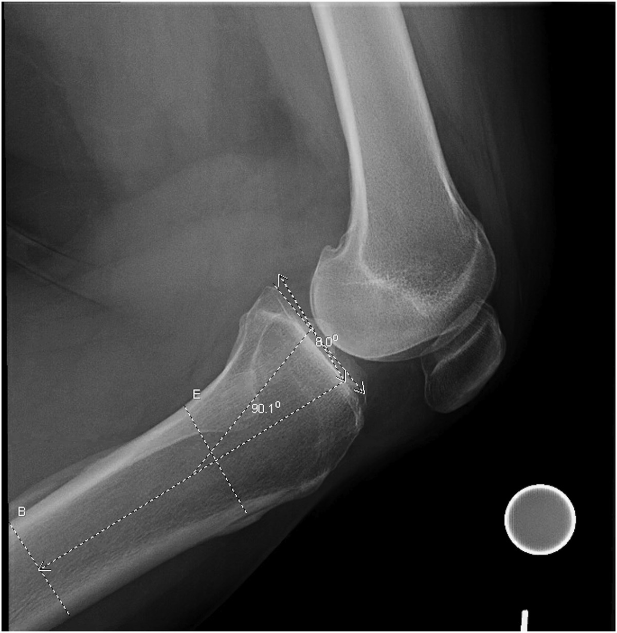 New Considerations in ACL Surgery: When Is Anatomic Reconstruction Not Enough?