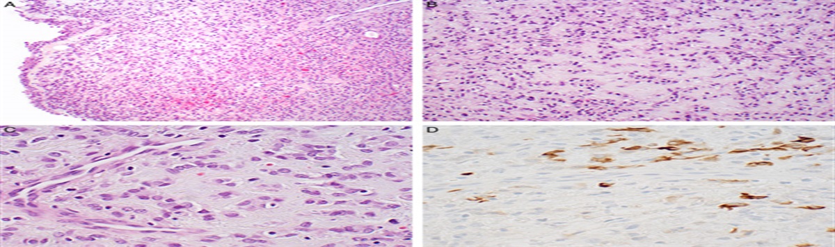Ossifying Fibromyxoid Tumor of the Genitourinary Tract: Report of 4 Molecularly Confirmed Cases of a Diagnostic Pitfall