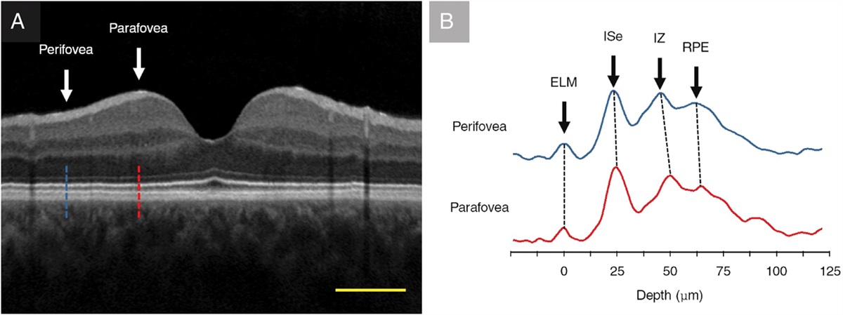COMPARATIVE ANALYSIS OF OCT AND OCT ANGIOGRAPHY CHARACTERISTICS IN EARLY DIABETIC RETINOPATHY
