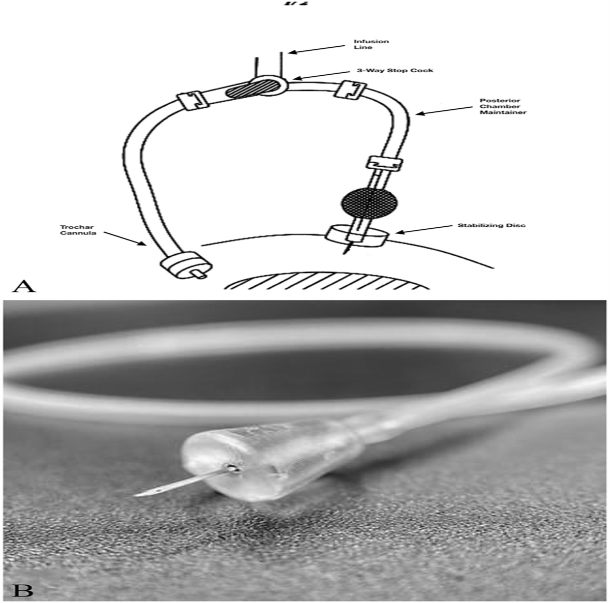 A 30 G “POSTERIOR CHAMBER MAINTAINER” FOR PREVENTION OF TRANSIENT HYPOTONY DURING SCLEROTOMY CLOSURE AT THE CONCLUSION OF 3-PORT PARS PLANA VITRECTOMY