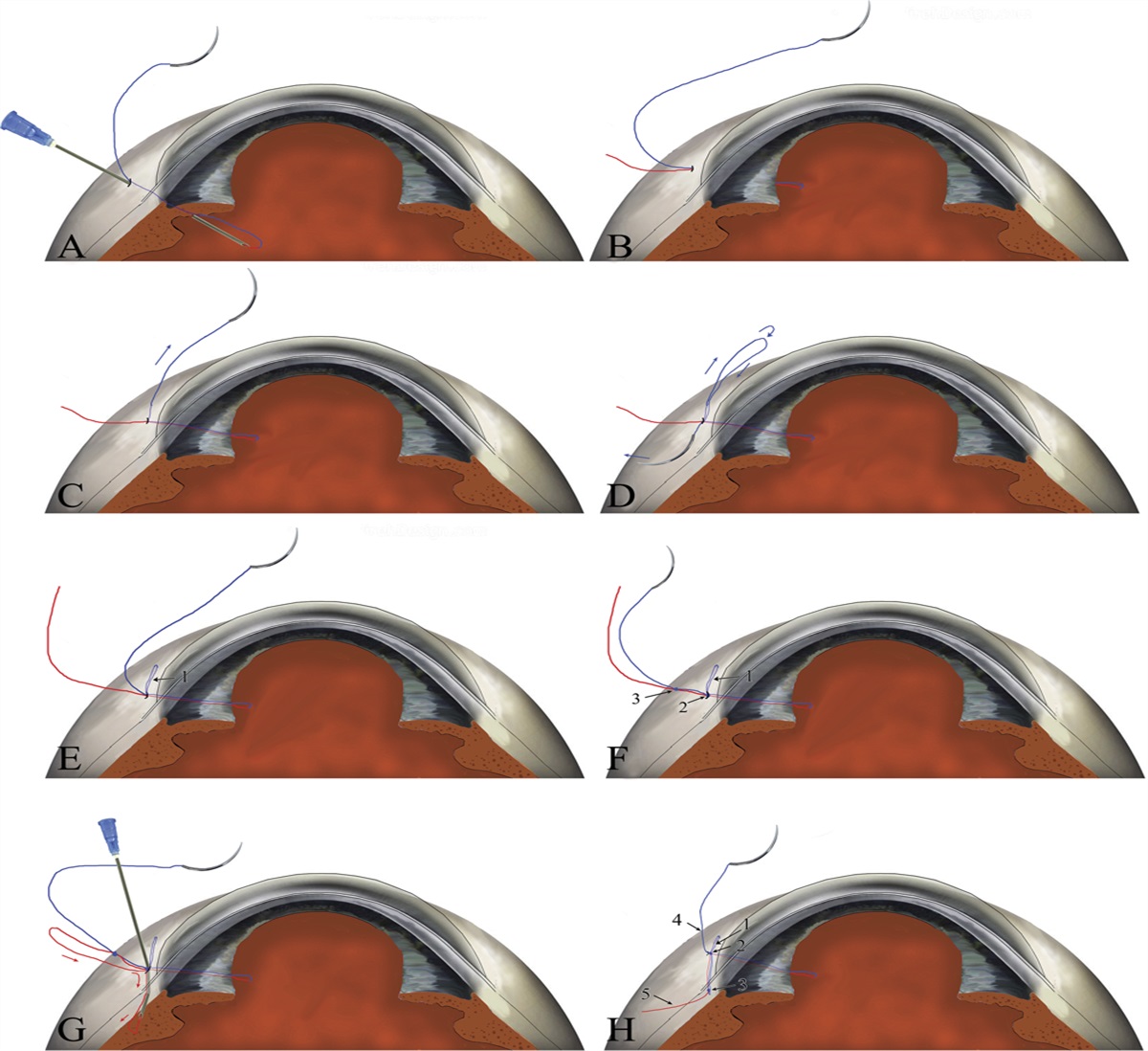 Flapless Intrascleral Knotting Technique for Suture Fixation of Intraocular Implants