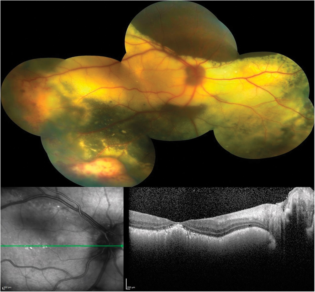 An Unusual Optical Coherence Tomography Appearance in Coats Disease