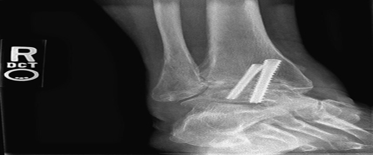 Conversion of Symptomatic Ankle Arthrodesis Nonunion to Total Ankle Arthroplasty Using Patient-specific Instrumentation and Computer-assisted Surgery Guides: A Case Report