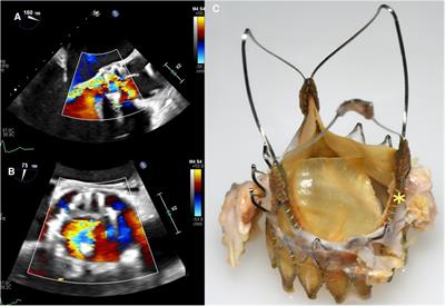 Severe structural valve deterioration after TAVR with ACURATE Neo: report of two cases