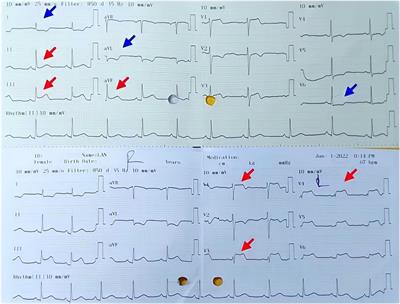 A case report and literature review of myocardial infarction with nonobstructive coronary arteries (MINOCA) possibly due to acute coronary vasospasm induced by misoprostol