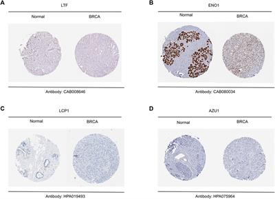 Prediction of prognosis and immunotherapy response in breast cancer based on neutrophil extracellular traps-related classification