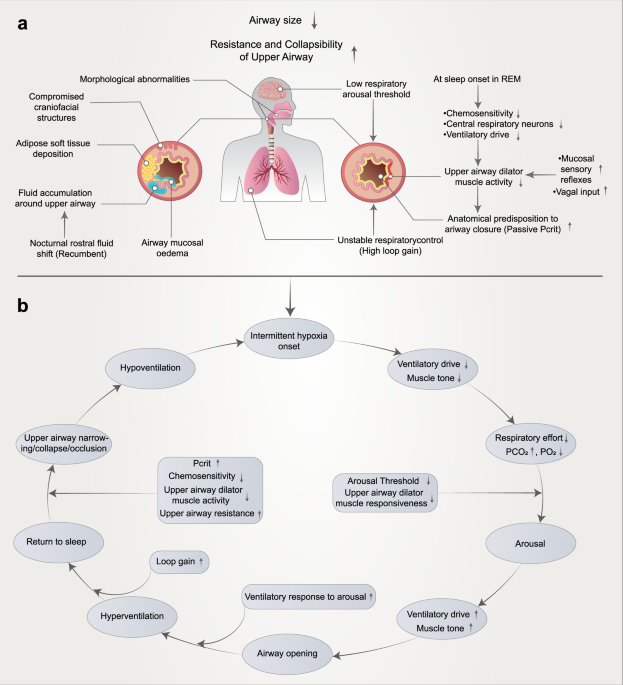 Pathophysiological mechanisms and therapeutic approaches in obstructive sleep apnea syndrome