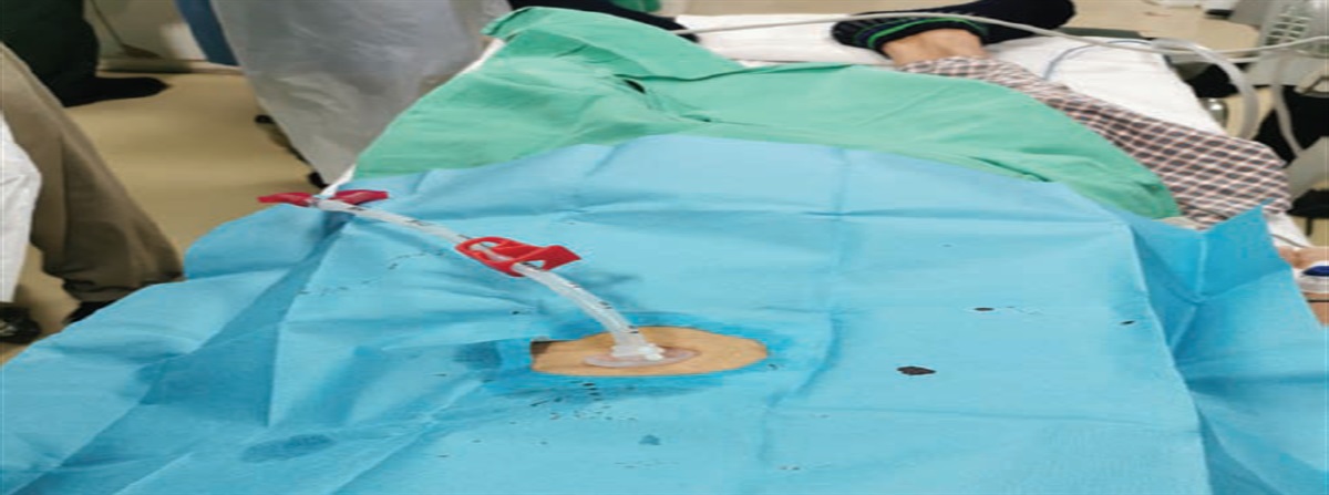 Why is this patient's percutaneous endoscopic gastrostomy tube leaking?