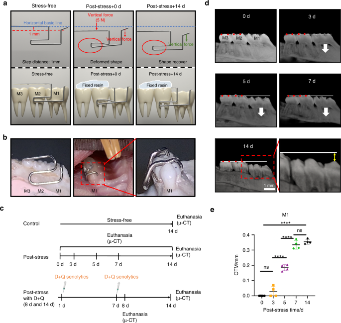 RANKL+ senescent cells under mechanical stress: a therapeutic target for orthodontic root resorption using senolytics