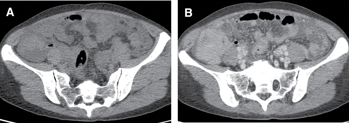 Aggressive systemic mastocytosis of colon and lymph node: A case report
