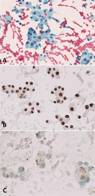 Immunohistochemistry in the pathologic diagnosis and management of thyroid neoplasms