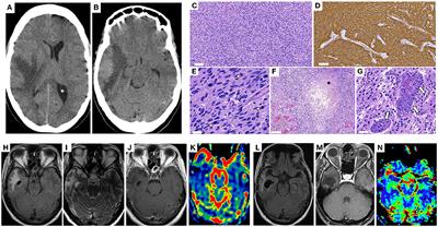Case report: Regression of Glioblastoma after flavivirus infection