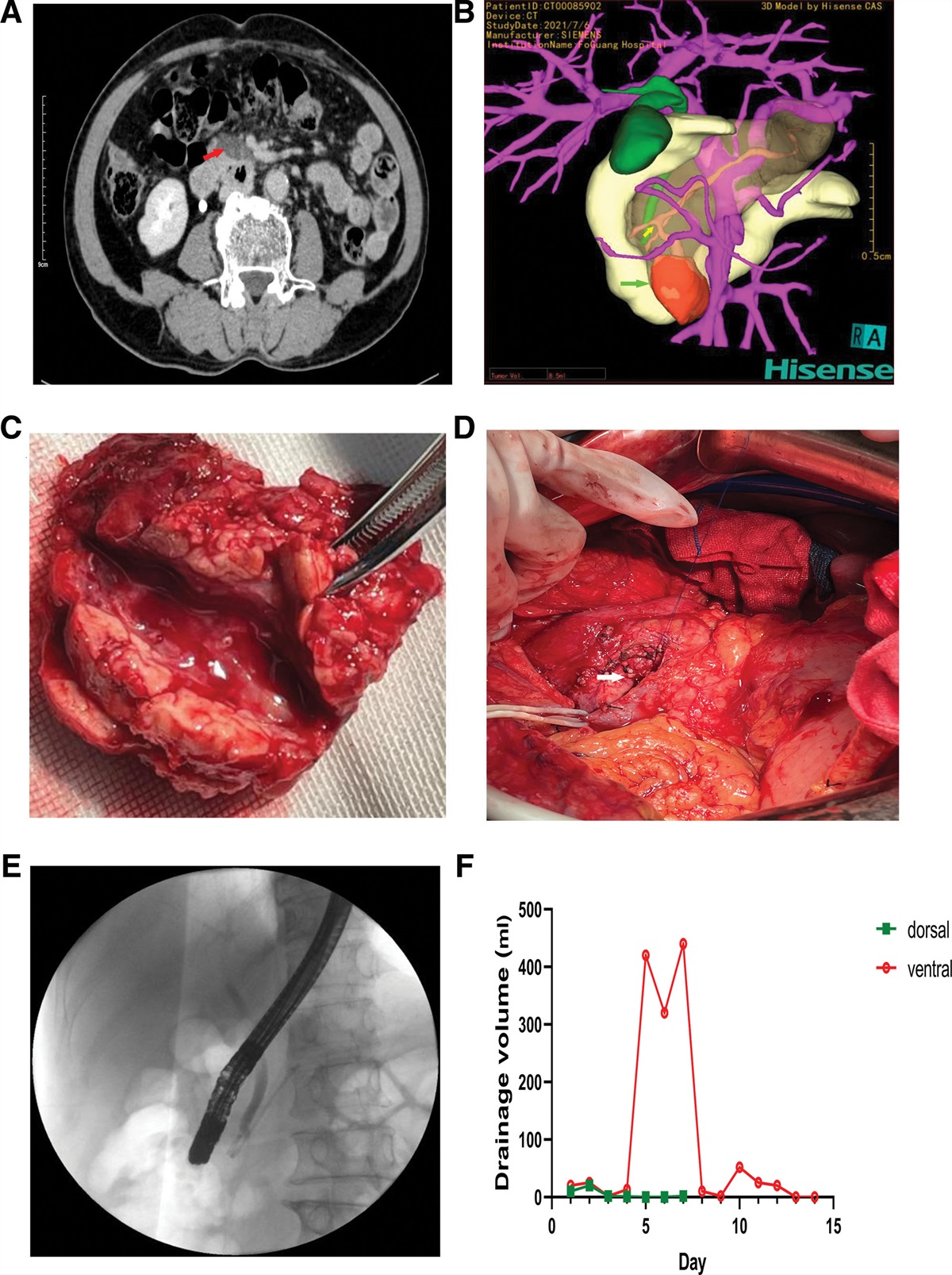 Intraductal papillary mucinous neoplasm of the accessory pancreatic duct in the pancreas uncinate process: A case report